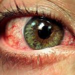 Gesprongen bloedvaten in oog: een bloedoog